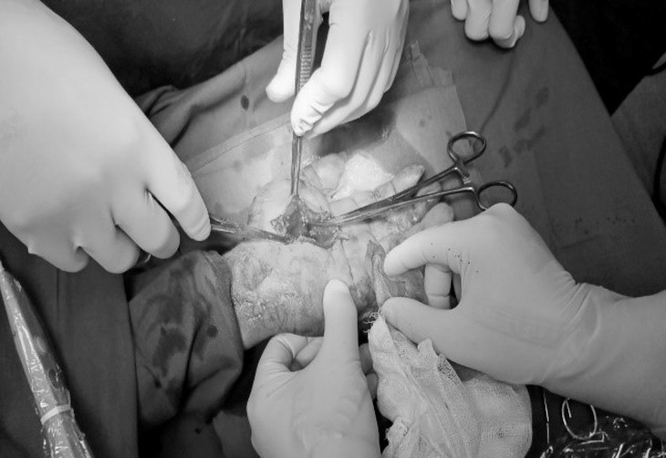 Ngã khi tay cầm cốc thủy tinh, người đàn ông tổn thương nghiêm trọng bàn tay trái - Ảnh 1. Ngã khi tay cầm cốc thủy tinh, người đàn ông tổn thương nghiêm trọng bàn tay trái - Ảnh 1.