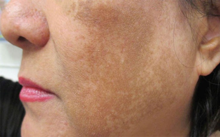 Sạm, nám da nhiều hơn sau điều trị và cách khắc phục