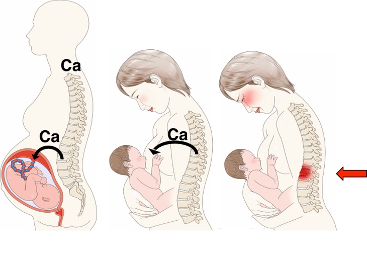 Vì sao phụ nữ sau sinh bị loãng xương? - Ảnh 1.
