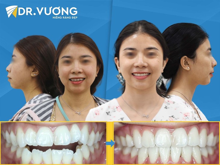 Thế nào là một ca niềng răng thành công? - Ảnh 2.