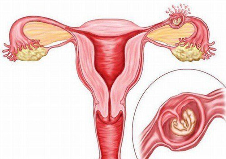 Bệnh lây truyền qua đường tình dục Chlamydia có thể gây ra những vấn đề gì? - Ảnh 4.