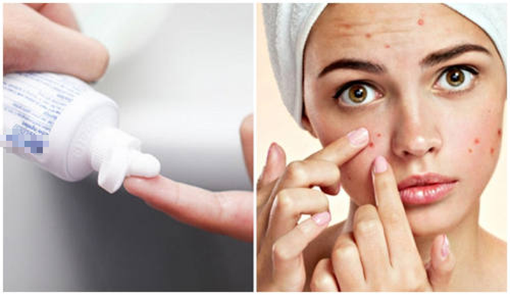 Giới trẻ đua nhau dùng kem đánh răng trị mụn: Chuyên gia cảnh báo "chữa lợn lành thành lợn què" - Ảnh 1.