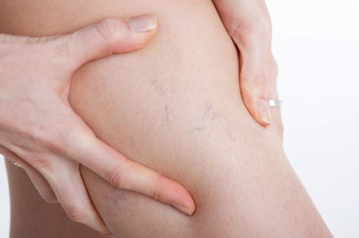 Suy giãn tĩnh mạch chân chữa thế nào và có cần phải phẫu thuật? - Ảnh 4.