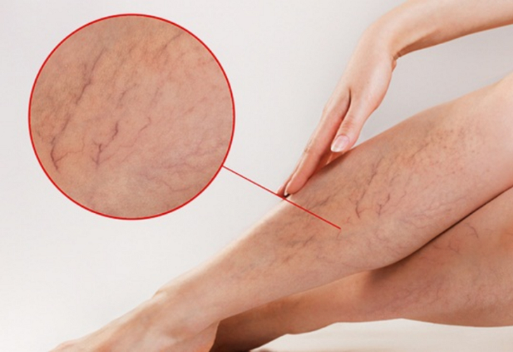 Suy giãn tĩnh mạch chân chữa thế nào và có cần phải phẫu thuật? - Ảnh 2.