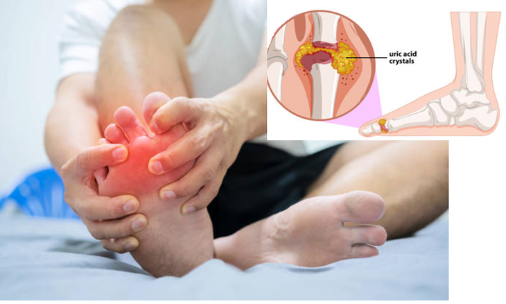 Người mắc bệnh gout nên chọn loại sữa nào? - Ảnh 2.