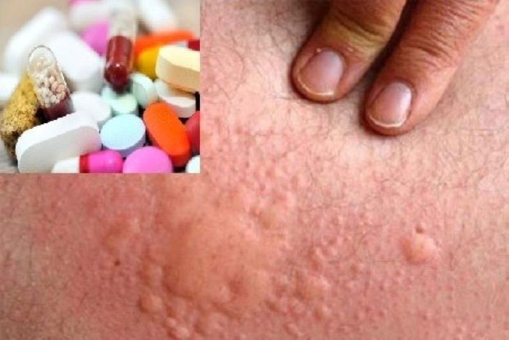 Sự khác nhau của thuốc kháng histamin và corticoid trong điều trị dị ứng - Ảnh 1.