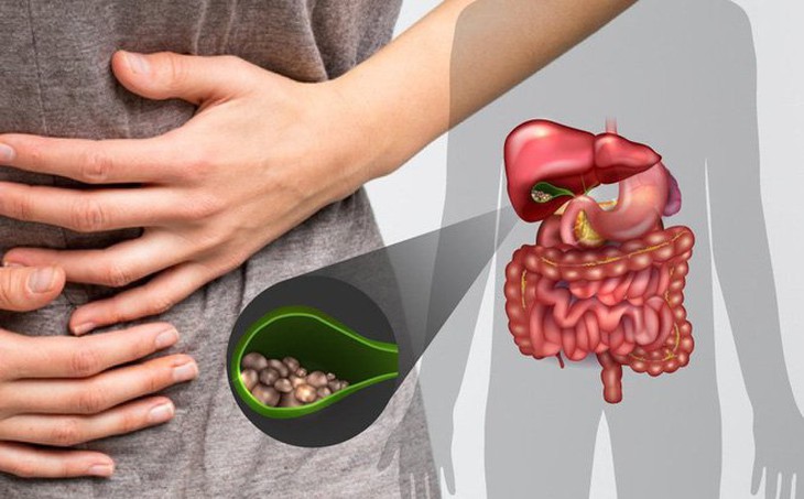 Polyp túi mật là gì? Bệnh có nguy hiểm? - Ảnh 2. Polyp túi mật là gì? Bệnh có nguy hiểm? - Ảnh 2.