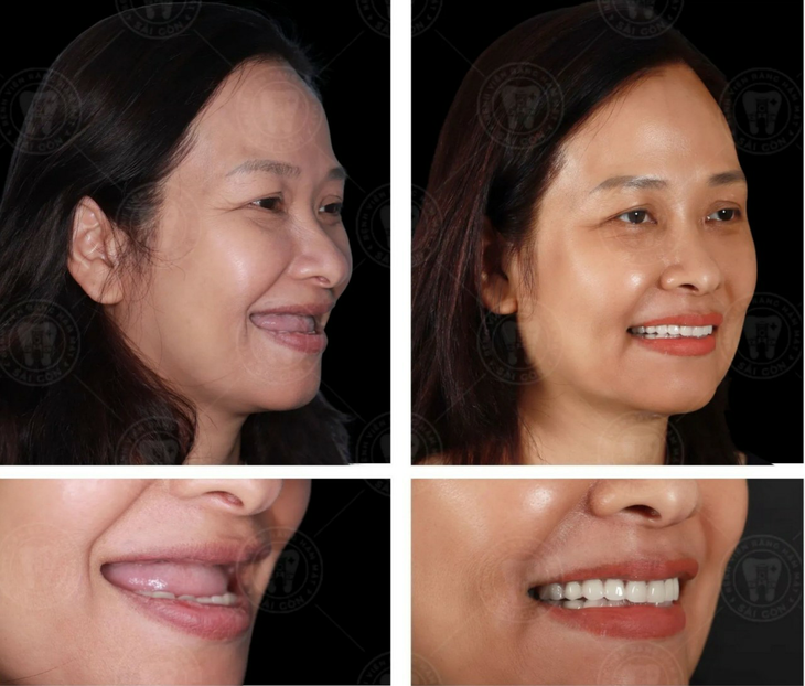 Chăm sóc răng hàm mặt – món quà ý nghĩa cho sức khỏe người lớn tuổi - Ảnh 3.