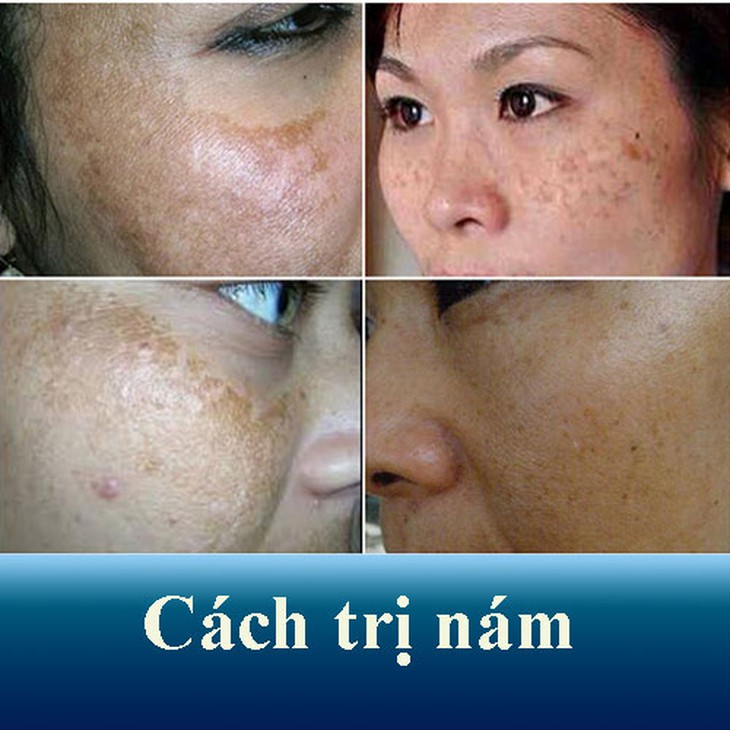 Để chẩn đoán bệnh rám má, bác sĩ chuyên khoa sẽ kiểm tra tình trạng da, dùng thiết bị đèn cực tím soi trực tiếp lên da trong phòng tối để đánh giá tổn thương từ đó đưa ra những kết luận chính xác về bệnh.