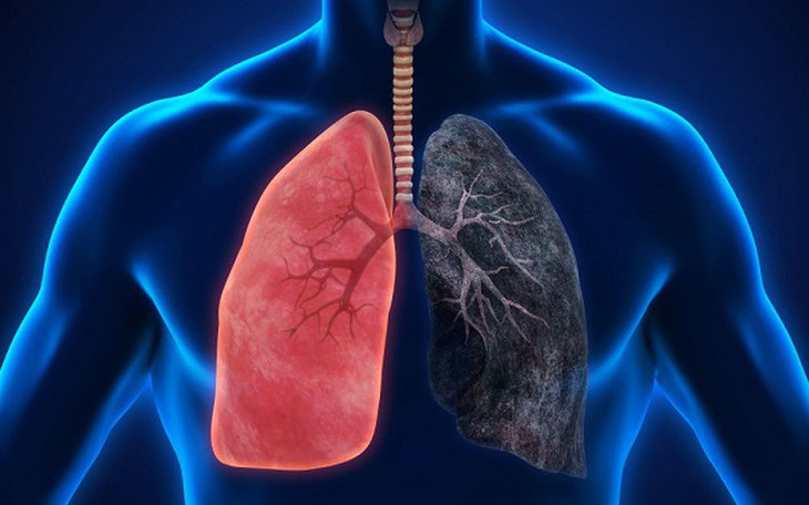 Các tác dụng phụ thường gặp khi điều trị ung thư phổi