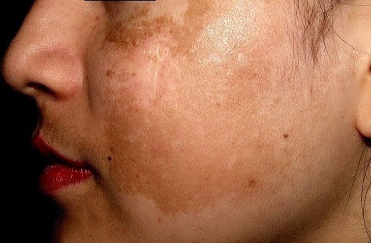 Rám má - Melasma là hiện tượng tăng sắc tố da lành tính, thường gặp.
