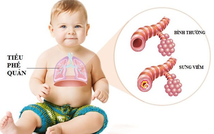 Chữa viêm tiểu phế quản ở trẻ như thế nào?