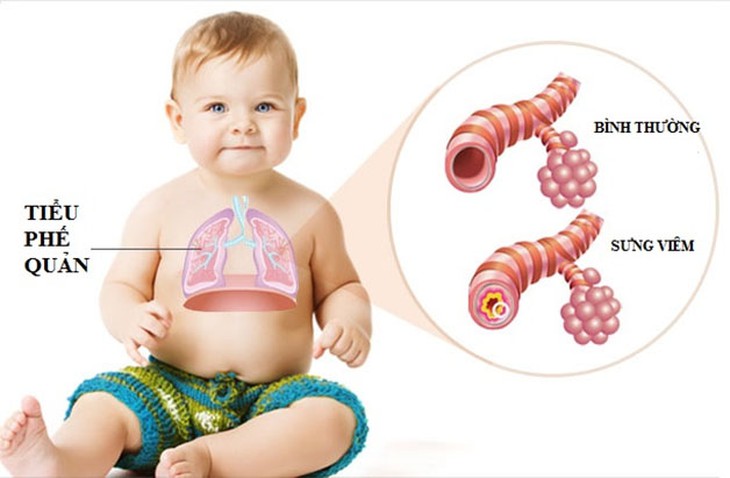 Chữa viêm tiểu phế quản ở trẻ như thế nào? - Ảnh 2.