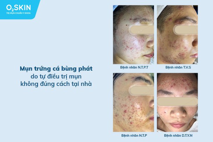 Tự trị mụn, tưởng rẻ mà không rẻ - Ảnh 1. Tự trị mụn, tưởng rẻ mà không rẻ - Ảnh 1.
