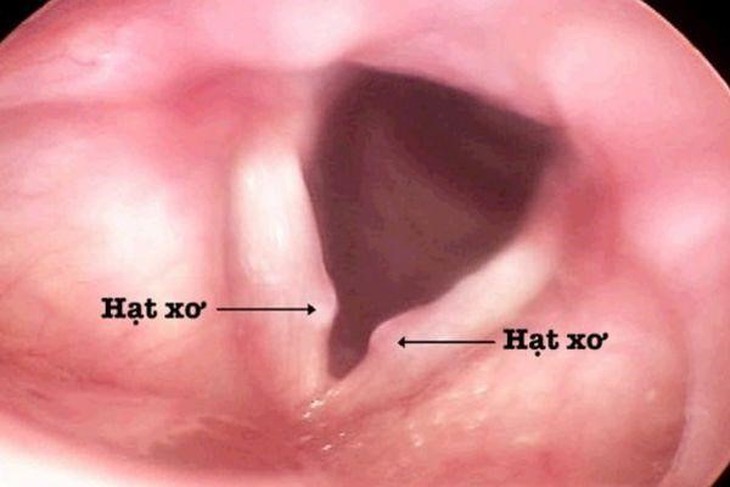 Giải pháp từ thảo dược hỗ trợ giảm viêm thanh quản do hạt xơ - Ảnh 1. Giải pháp từ thảo dược hỗ trợ giảm viêm thanh quản do hạt xơ - Ảnh 1.