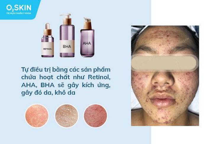 Tự trị mụn, tưởng rẻ mà không rẻ - Ảnh 2. Tự trị mụn, tưởng rẻ mà không rẻ - Ảnh 2.