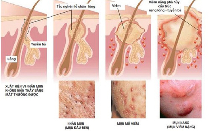 Những điều cần biết về điều trị mụn trứng cá