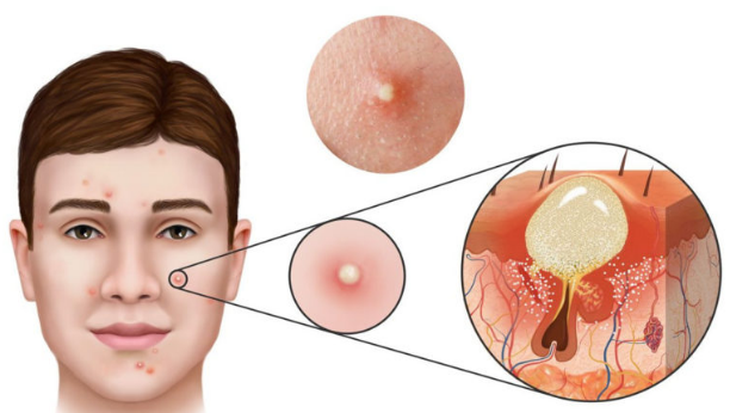 Mụn trứng cá - những điều cần biết về điều trị - Ảnh 1. Mụn trứng cá - những điều cần biết về điều trị - Ảnh 1.