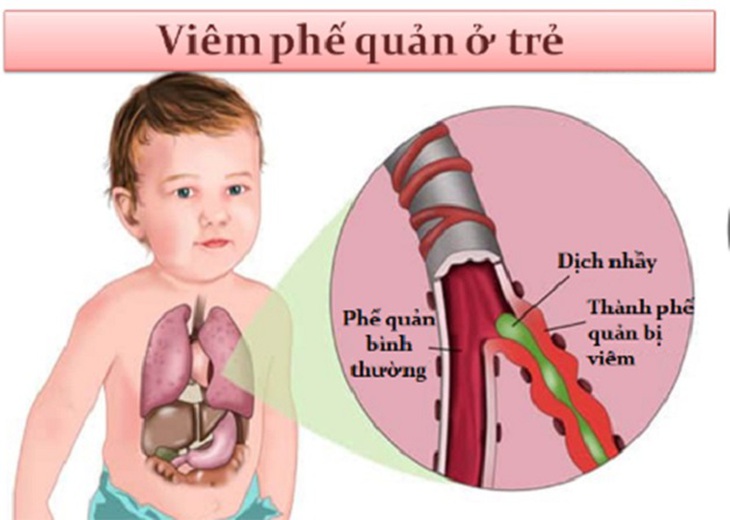 Chăm sóc trẻ viêm phế quản đúng cách để giúp trẻ mong chóng hồi phục - Ảnh 2.