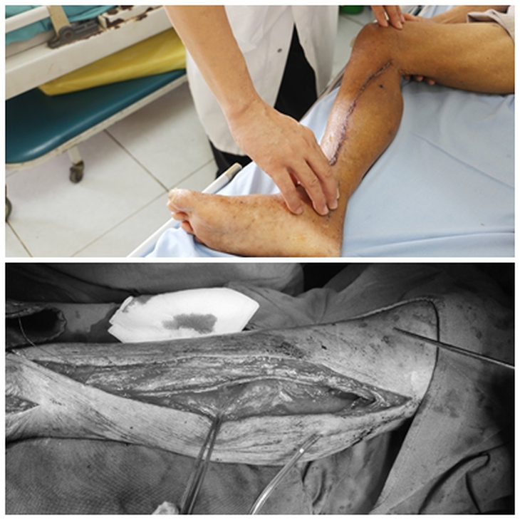 Thoát cắt cụt chân trong gang tấc nhờ đến viện kịp thời - Ảnh 1.