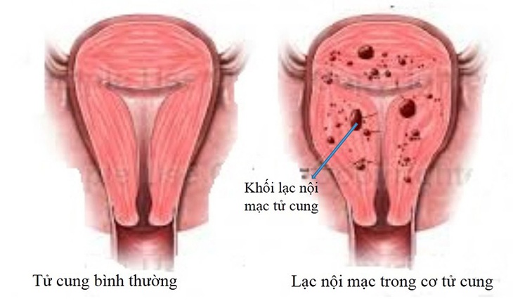 Lạc nội mạc tử cung ảnh hưởng đến chu kỳ kinh nguyệt như thế nào? - Ảnh 2. Lạc nội mạc tử cung ảnh hưởng đến chu kỳ kinh nguyệt như thế nào? - Ảnh 2.