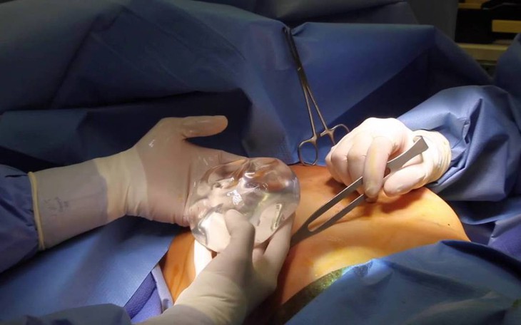 Tin lời quảng cáo nâng ngực không cần phẫu thuật, nhiêfu bệnh nhân phải nhập viện vì tổn thương vú - Ảnh 1. Tin lời quảng cáo nâng ngực không cần phẫu thuật, nhiêfu bệnh nhân phải nhập viện vì tổn thương vú - Ảnh 1.