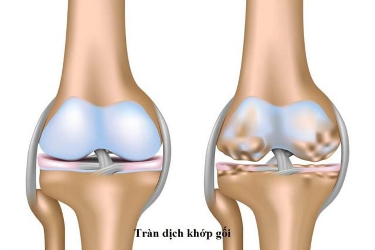 Đau khớp gối là tình trạng xuất hiện những cơn đau ở gối và khu vực xung quanh, có thể gặp ở mọi lứa tuổi.