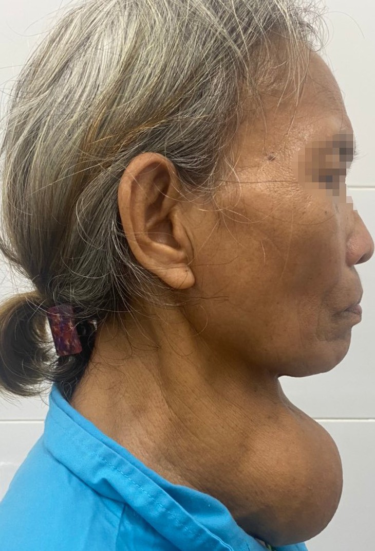 Bóc tách u tuyến giáp 'khổng lồ' nặng 1,5 kg ở người phụ nữ - Ảnh 1.