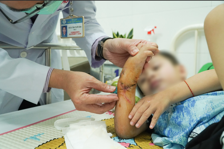 Bác sĩ BV Chợ Rẫy kịp thời "cứu" cánh tay bé 5 tuổi bị đứt lìa do tai nạn giao thông - Ảnh 1.