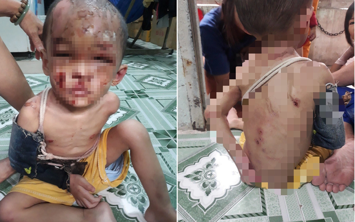 Kết quả điều tra ban đầu vụ bé trai nghi bị bạo hành ở Hóc Môn