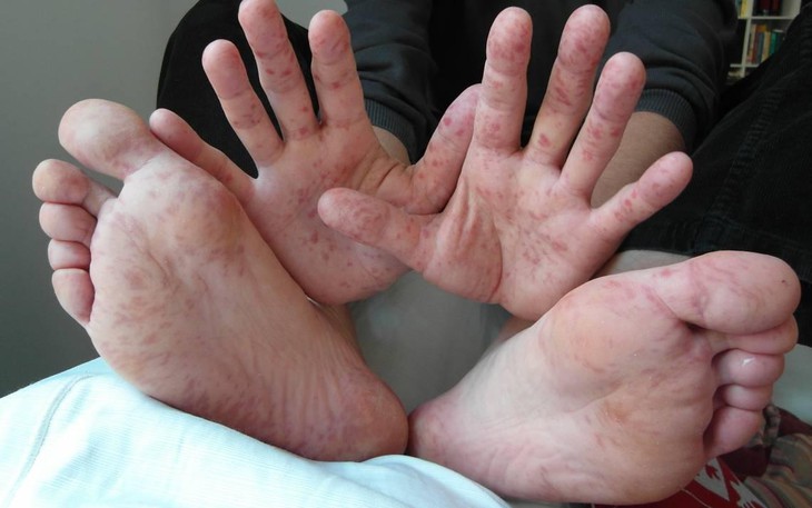 7 sai lầm thường gặp khi điều trị tay chân miệng cho trẻ