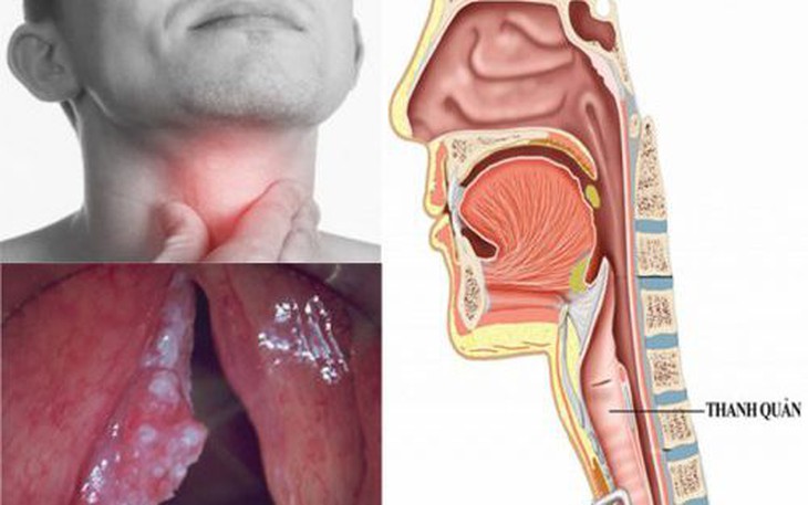 Khàn tiếng, mất tiếng người đàn ông 59 tuổi bất ngờ được chẩn đoán ung thư thanh quản