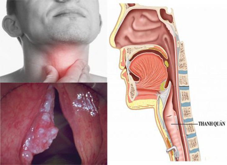 Hút thuốc lá, uống rượu người đàn ông 59 tuổi mắc ung thư thanh quản - Ảnh 2. Hút thuốc lá, uống rượu người đàn ông 59 tuổi mắc ung thư thanh quản - Ảnh 2.