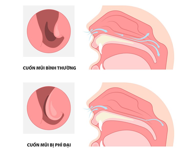 Ngạt mũi liên tục gây khó thở, khó ngủ do nguyên nhân gì và cách điều trị - Ảnh 1. Ngạt mũi liên tục gây khó thở, khó ngủ do nguyên nhân gì và cách điều trị - Ảnh 1.