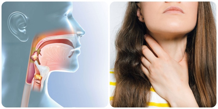 Biểu hiện cảnh báo ung thư vòm họng giai đoạn đầu- Ảnh 1. Biểu hiện cảnh báo ung thư vòm họng giai đoạn đầu- Ảnh 1.