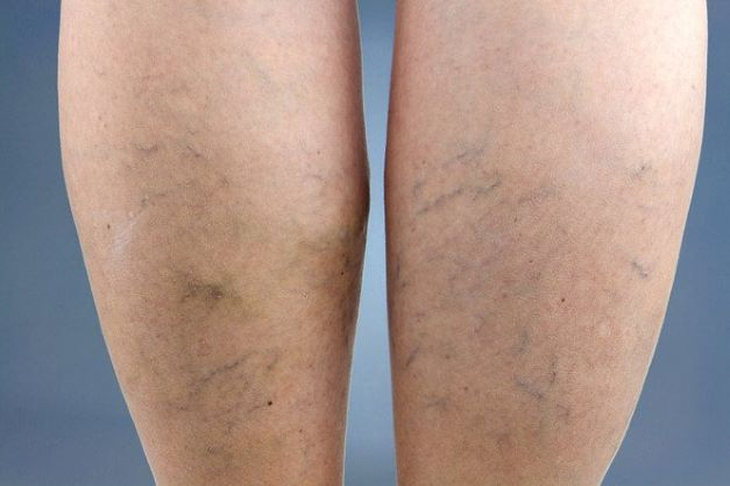 Những bệnh có thể mắc do mặc quần áo bó và cách khắc phục - Ảnh 3.