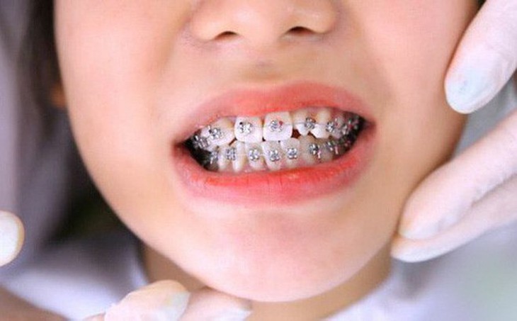 Niềng răng có phải kiêng ăn uống gì không? - Ảnh 2.