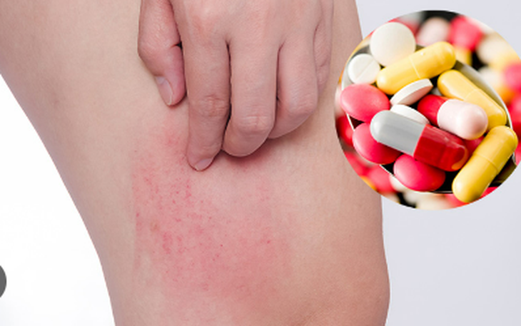 Điều gì sẽ xảy ra nếu bạn bị ốm và tự ra hiệu thuốc mua kháng sinh về uống?