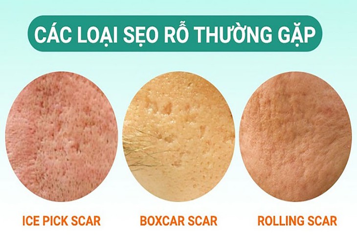 Cách chăm sóc và điều trị sẹo rỗ - Ảnh 1.