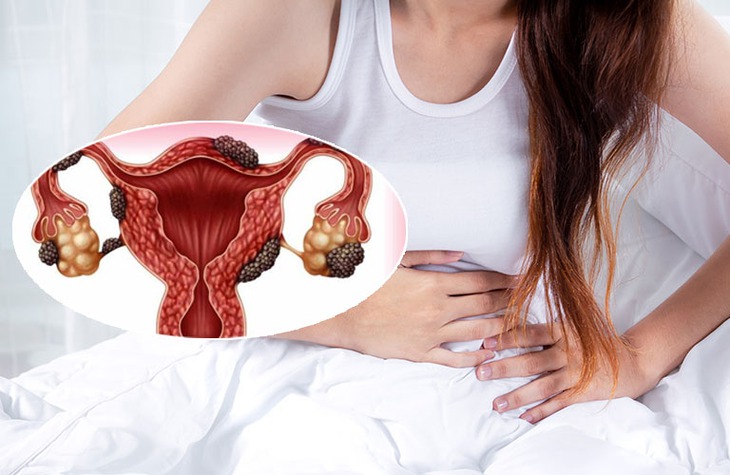 Cứ đến tháng máu lại rỉ từ vết mổ đẻ cũ là triệu chứng của bệnh gì? - Ảnh 1. Cứ đến tháng máu lại rỉ từ vết mổ đẻ cũ là triệu chứng của bệnh gì? - Ảnh 1.