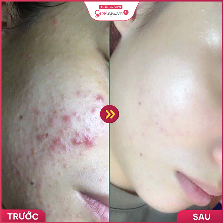 Địa điểm trị mụn an toàn và hiệu quả được nhiều người phản hồi tích cực - Ảnh 2. Địa điểm trị mụn an toàn và hiệu quả được nhiều người phản hồi tích cực - Ảnh 2.