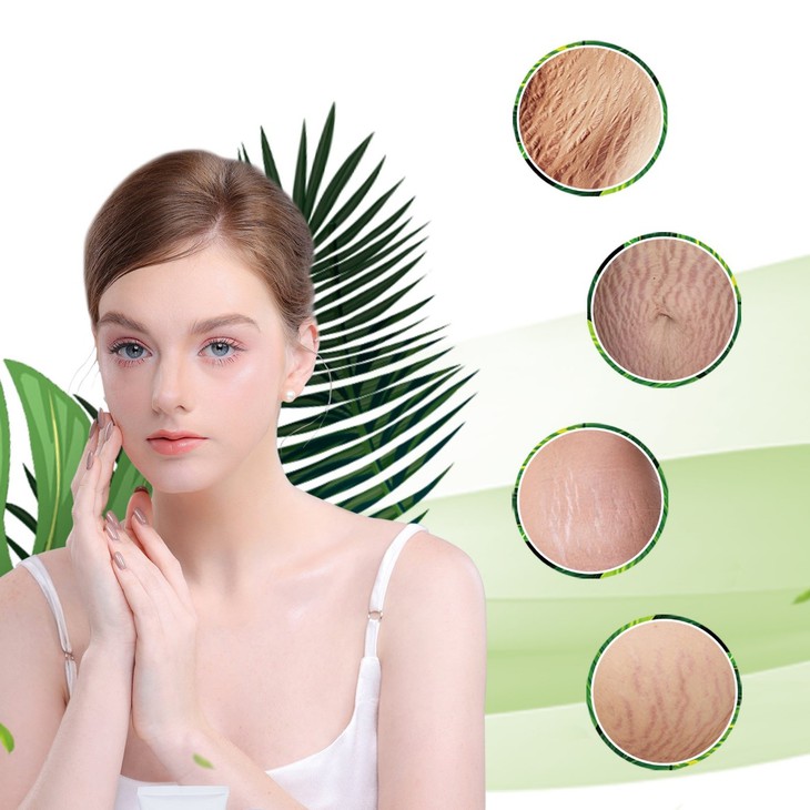 Giải pháp cho những làn da bị rạn, "cứu tinh" của nhiều chị em - Ảnh 3. Giải pháp cho những làn da bị rạn, "cứu tinh" của nhiều chị em - Ảnh 3.