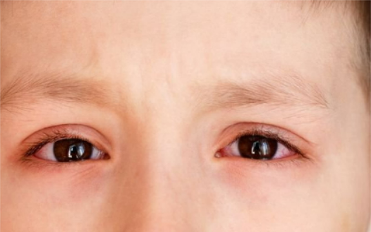 Ngứa mắt và đau mắt đỏ có thể là triệu chứng mới của COVID-19