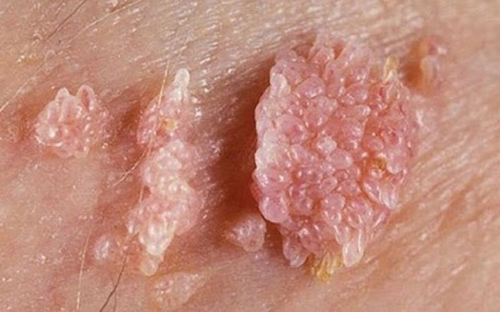 Sùi mào gà: Nguyên nhân, biểu hiện và các biện pháp chẩn đoán bệnh