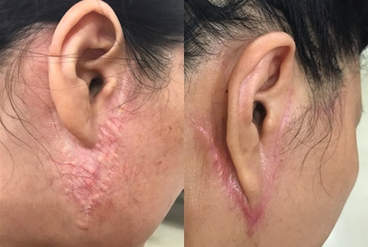 Căng da mặt bằng phẫu thuật có trẻ vĩnh viễn không? - Ảnh 1.