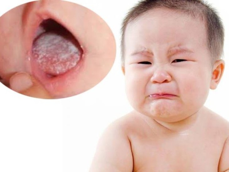 Điều trị nấm lưỡi ở trẻ em - Ảnh 1. Điều trị nấm lưỡi ở trẻ em - Ảnh 1.