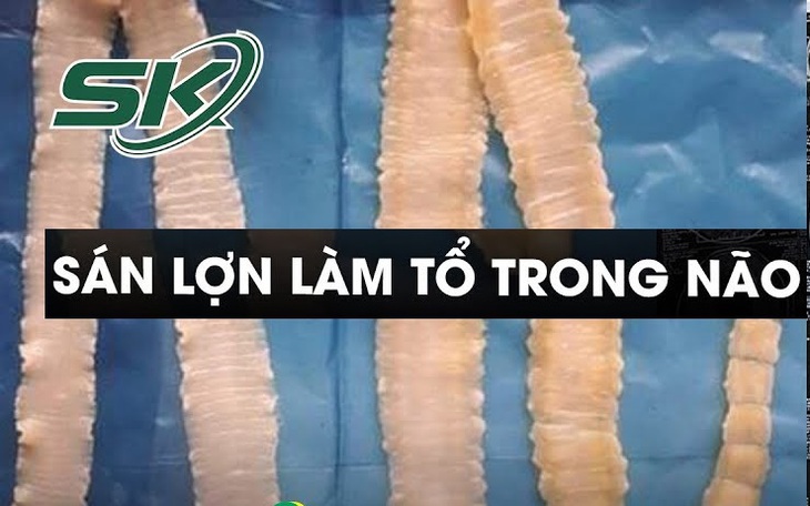 Tưởng tâm thần hóa sán lợn làm tổ trong não