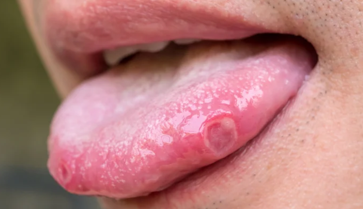 Bệnh mụn rộp sinh dục là gì? Biểu hiện mắc mụn rộp sinh dục - Ảnh 2.