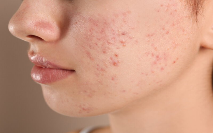 Điều trị mụn trứng cá dùng thuốc gì?