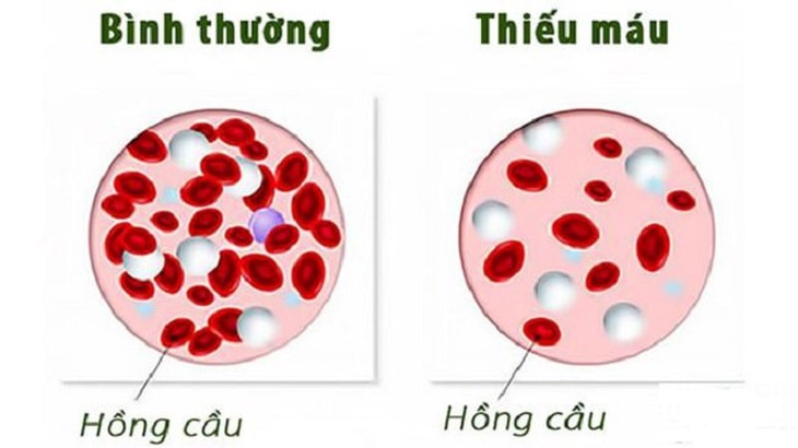 Để điều trị thiếu máu nhược sắc các bác sĩ sẽ chỉ định cho bạn uống các viên uống hoặc sẽ chỉ đỉnh cho bệnh nhân truyền máu qua đường tĩnh mạch, tiêm hormone để tăng sản xuất hồng cầu. Để điều trị thiếu máu nhược sắc các bác sĩ sẽ chỉ định cho bạn uống các viên uống hoặc sẽ chỉ đỉnh cho bệnh nhân truyền máu qua đường tĩnh mạch, tiêm hormone để tăng sản xuất hồng cầu.